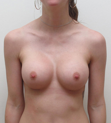 Breast Augmentation Silicone Implants Before and After | CIARAVINO Plastic Surgery