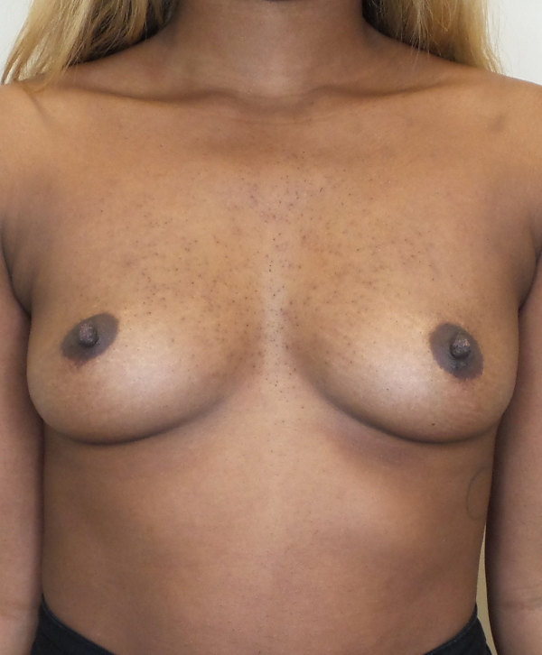 Breast Augmentation Silicone Implants Before and After | CIARAVINO Plastic Surgery