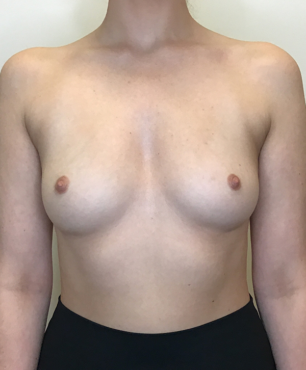 Breast Augmentation Silicone Implants Before and After | CIARAVINO Plastic Surgery