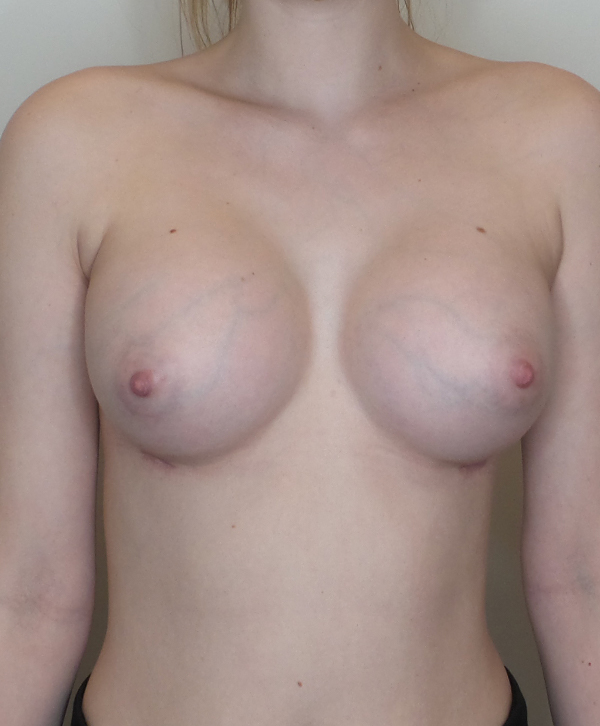 Breast Augmentation Silicone Implants Before and After | CIARAVINO Plastic Surgery