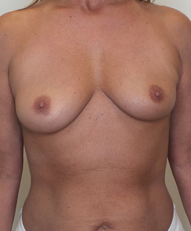 Breast Augmentation Silicone Implants Before and After | CIARAVINO Plastic Surgery