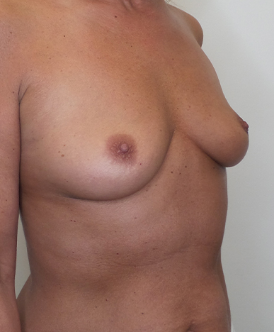 Breast Augmentation Silicone Implants Before and After | CIARAVINO Plastic Surgery