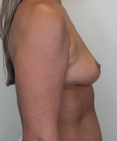 Breast Augmentation Silicone Implants Before and After | CIARAVINO Plastic Surgery