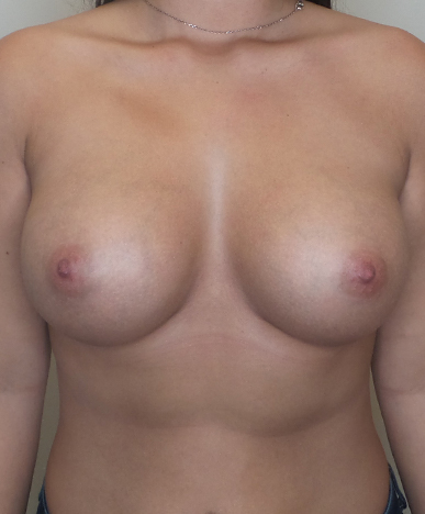 Breast Augmentation Silicone Implants Before and After | CIARAVINO Plastic Surgery