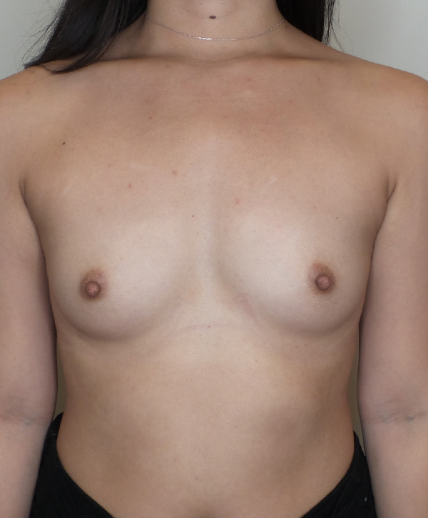 Breast Augmentation Silicone Implants Before and After | CIARAVINO Plastic Surgery