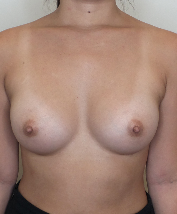 Breast Augmentation Silicone Implants Before and After | CIARAVINO Plastic Surgery