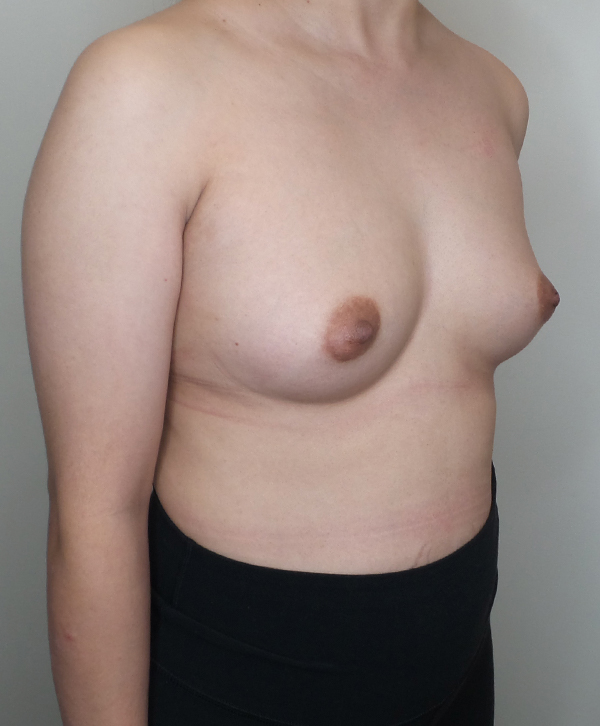 Breast Augmentation Silicone Implants Before and After | CIARAVINO Plastic Surgery