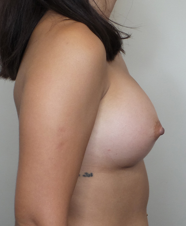 Breast Augmentation Silicone Implants Before and After | CIARAVINO Plastic Surgery