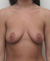 Breast Augmentation Silicone Implants Before and After | CIARAVINO Plastic Surgery