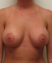 Breast Augmentation Silicone Implants Before and After | CIARAVINO Plastic Surgery