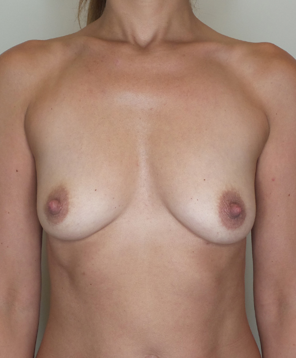 Breast Augmentation Silicone Implants Before and After | CIARAVINO Plastic Surgery