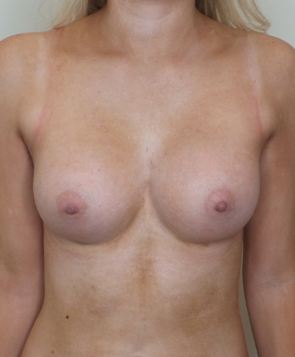 Breast Augmentation Silicone Implants Before and After | CIARAVINO Plastic Surgery