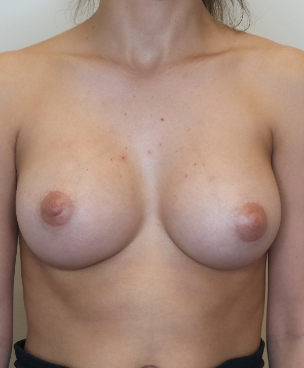 Breast Augmentation Silicone Implants Before and After | CIARAVINO Plastic Surgery