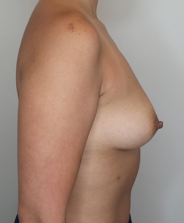 Breast Augmentation Silicone Implants Before and After | CIARAVINO Plastic Surgery