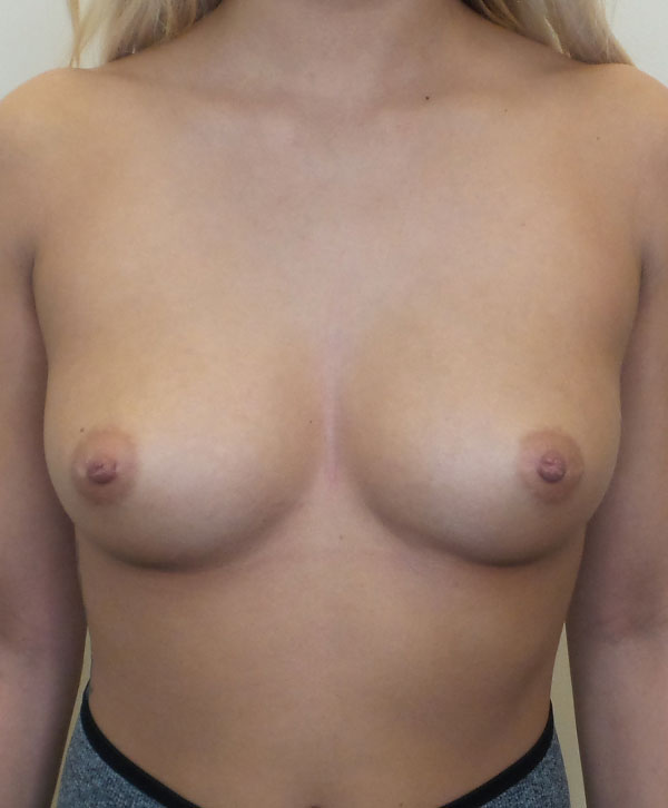 Breast Augmentation Silicone Implants Before and After | CIARAVINO Plastic Surgery