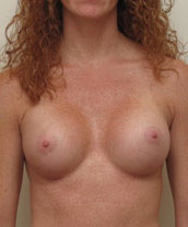 Breast Augmentation Silicone Implants Before and After | CIARAVINO Plastic Surgery