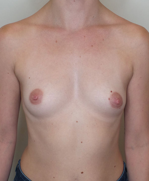 Breast Augmentation Silicone Implants Before and After | CIARAVINO Plastic Surgery