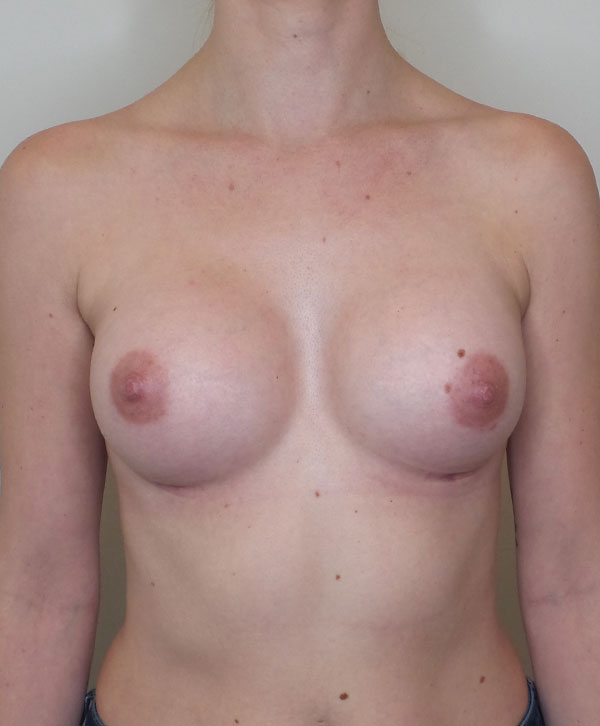 Breast Augmentation Silicone Implants Before and After | CIARAVINO Plastic Surgery