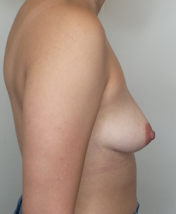 Breast Augmentation Silicone Implants Before and After | CIARAVINO Plastic Surgery