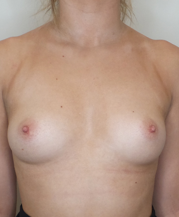 Breast Augmentation Silicone Implants Before and After | CIARAVINO Plastic Surgery