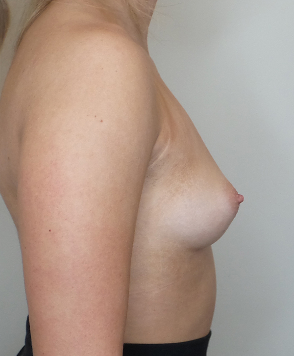 Breast Augmentation Silicone Implants Before and After | CIARAVINO Plastic Surgery