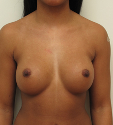 Breast Augmentation Silicone Implants Before and After | CIARAVINO Plastic Surgery