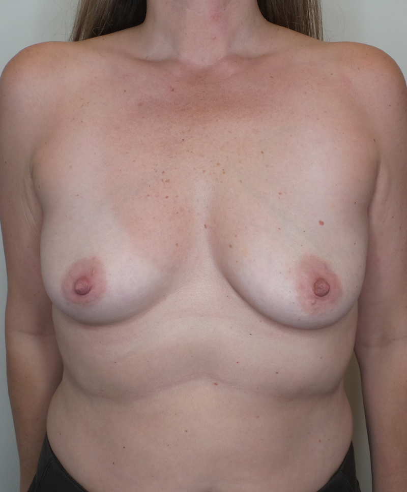 Breast Augmentation Silicone Implants Before and After | CIARAVINO Plastic Surgery