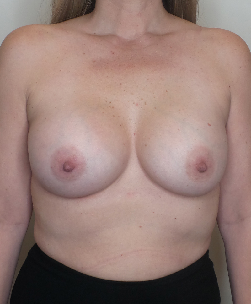 Breast Augmentation Silicone Implants Before and After | CIARAVINO Plastic Surgery