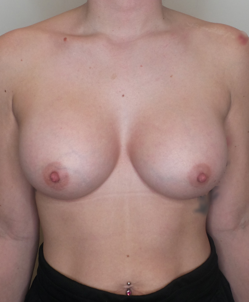 Breast Augmentation Silicone Implants Before and After | CIARAVINO Plastic Surgery