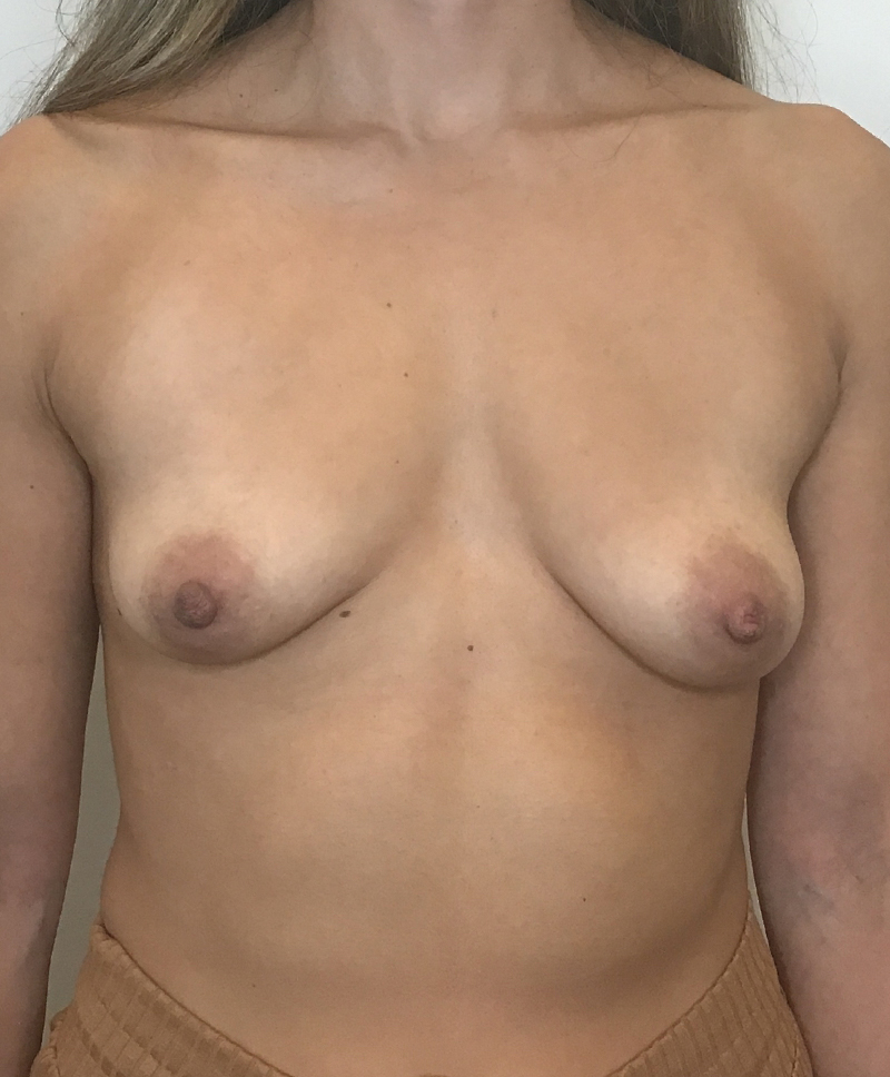 Breast Augmentation Silicone Implants Before and After | CIARAVINO Plastic Surgery