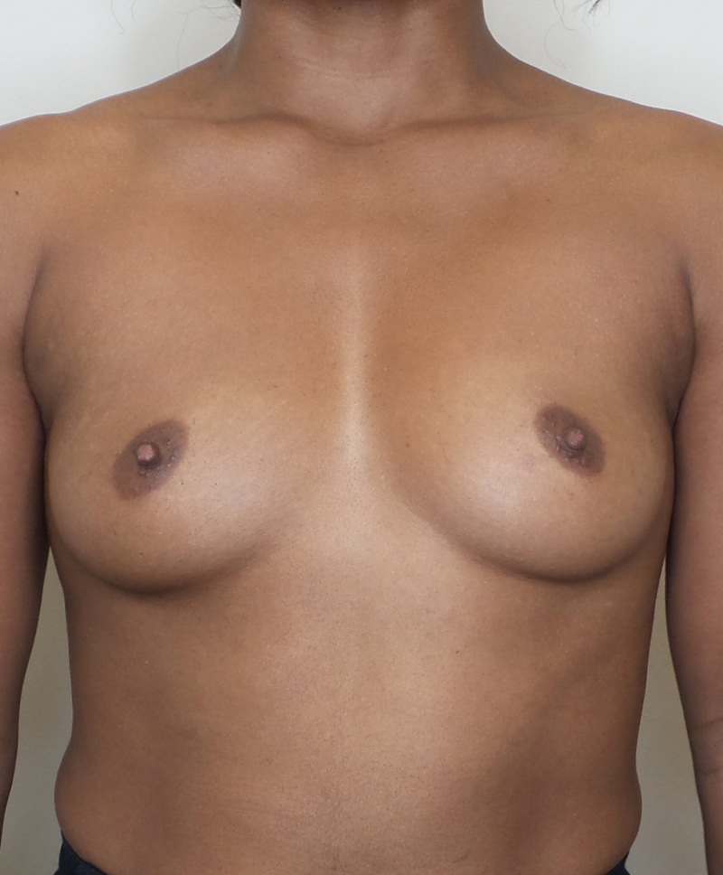 Breast Augmentation Silicone Implants Before and After | CIARAVINO Plastic Surgery