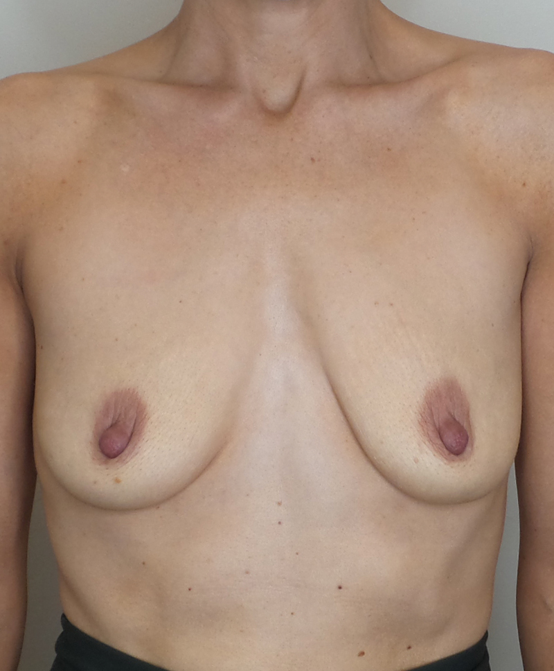 Breast Augmentation Silicone Implants Before and After | CIARAVINO Plastic Surgery