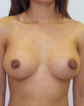 Breast Augmentation Silicone Implants Before and After | CIARAVINO Plastic Surgery