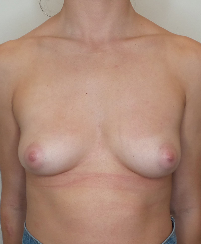 Breast Augmentation Silicone Implants Before and After | CIARAVINO Plastic Surgery