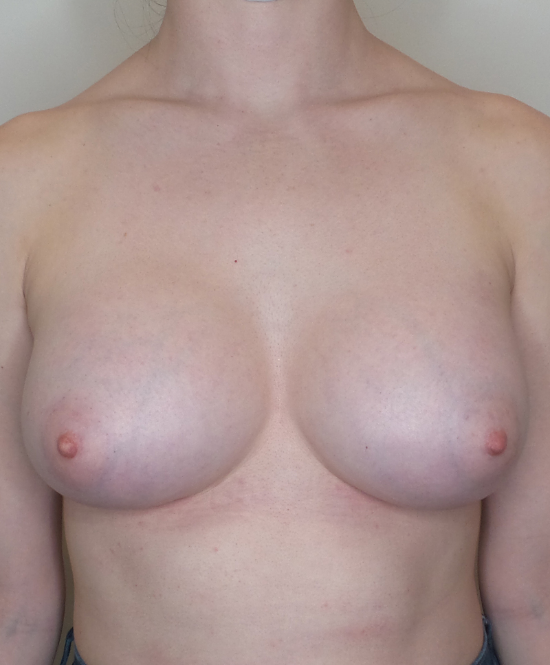 Breast Augmentation Silicone Implants Before and After | CIARAVINO Plastic Surgery