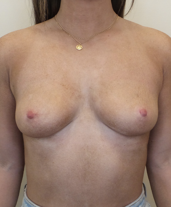 Breast Augmentation Silicone Implants Before and After | CIARAVINO Plastic Surgery