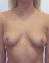 Breast Augmentation Silicone Implants Before and After | CIARAVINO Plastic Surgery