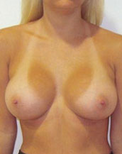 Breast Augmentation Silicone Implants Before and After | CIARAVINO Plastic Surgery