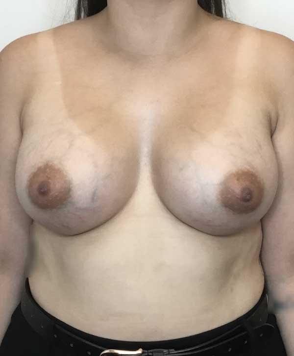 Breast Augmentation Silicone Implants Before and After | CIARAVINO Plastic Surgery