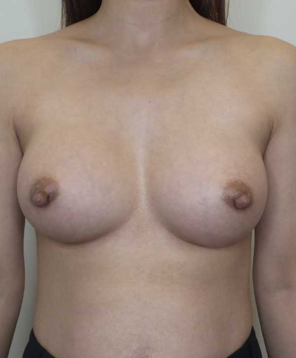 Breast Augmentation Silicone Implants Before and After | CIARAVINO Plastic Surgery