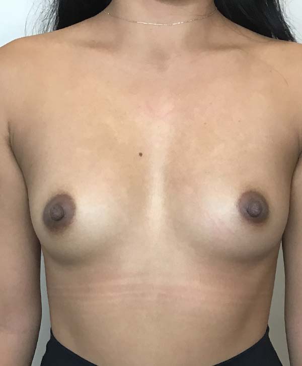 Breast Augmentation Silicone Implants Before and After | CIARAVINO Plastic Surgery