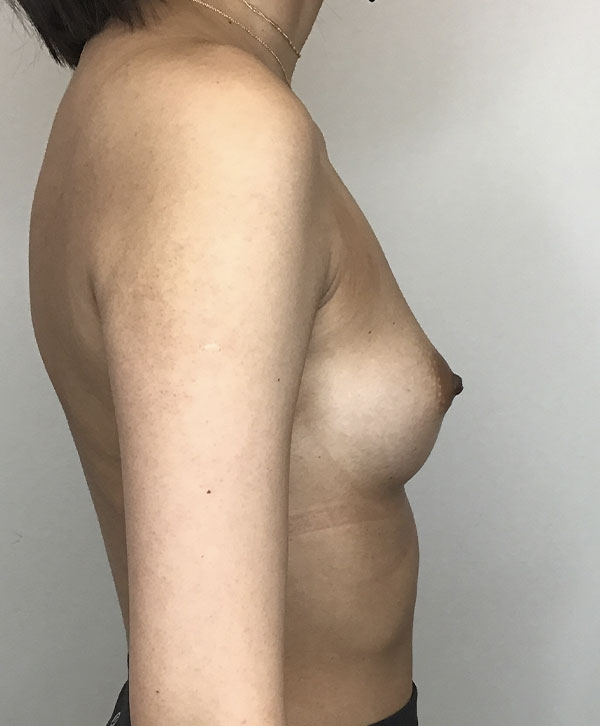 Breast Augmentation Silicone Implants Before and After | CIARAVINO Plastic Surgery