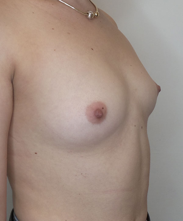 Breast Augmentation Silicone Implants Before and After | CIARAVINO Plastic Surgery