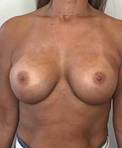 Breast Augmentation Silicone Implants Before and After | CIARAVINO Plastic Surgery