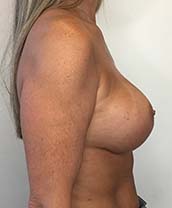 Breast Augmentation Silicone Implants Before and After | CIARAVINO Plastic Surgery