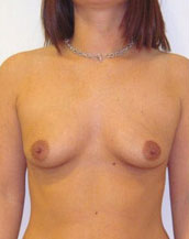 Breast Augmentation Silicone Implants Before and After | CIARAVINO Plastic Surgery