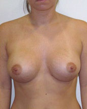 Breast Augmentation Silicone Implants Before and After | CIARAVINO Plastic Surgery