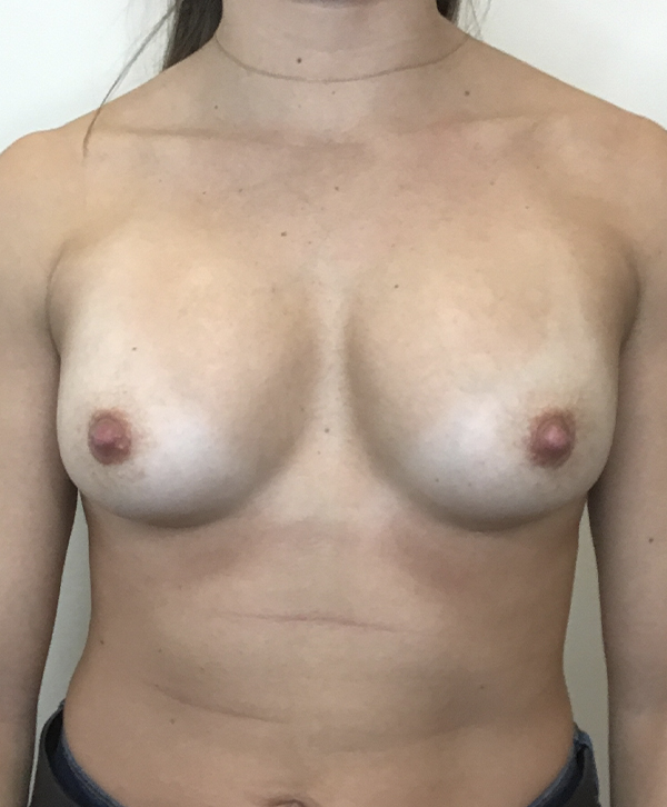 Breast Augmentation Silicone Implants Before and After | CIARAVINO Plastic Surgery