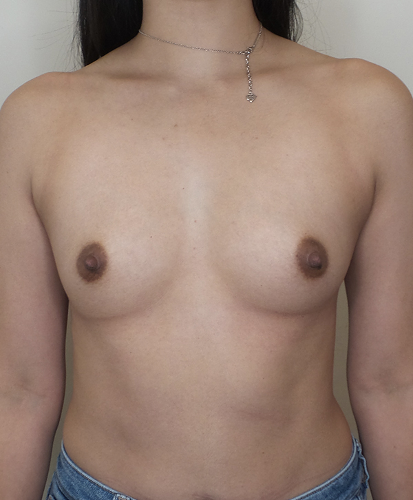 Breast Augmentation Silicone Implants Before and After | CIARAVINO Plastic Surgery