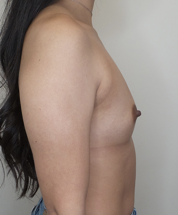 Breast Augmentation Silicone Implants Before and After | CIARAVINO Plastic Surgery